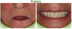 Protesis 01